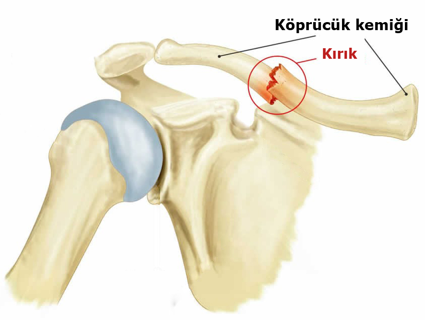 Kırık Tedavisi